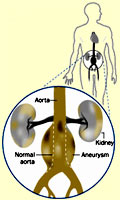 Aneurysm Diagram